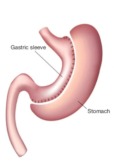 Figure of gastric sleeve and stomach.
